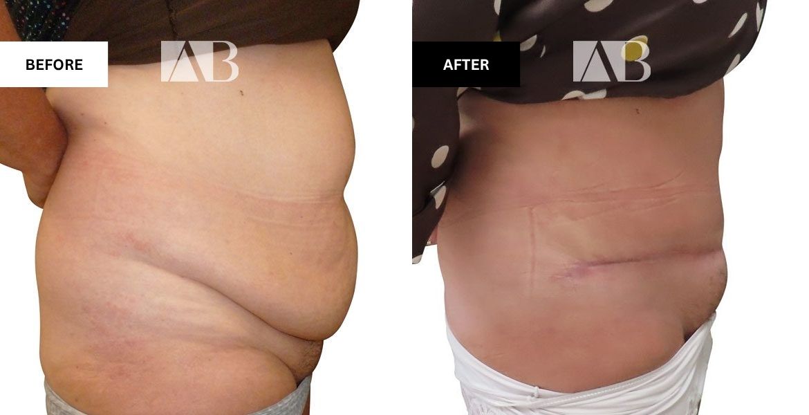 Tummy Tuck Before and After Photo Patient 5 - Right Side