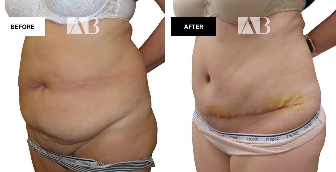 Tummy Tuck Before and After Photo Patient 6 - Left Side