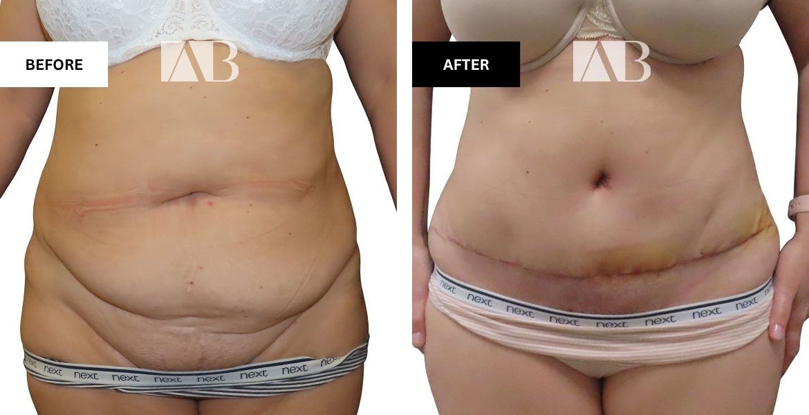 Tummy Tuck Before and After Photo Patient 6 - Front View