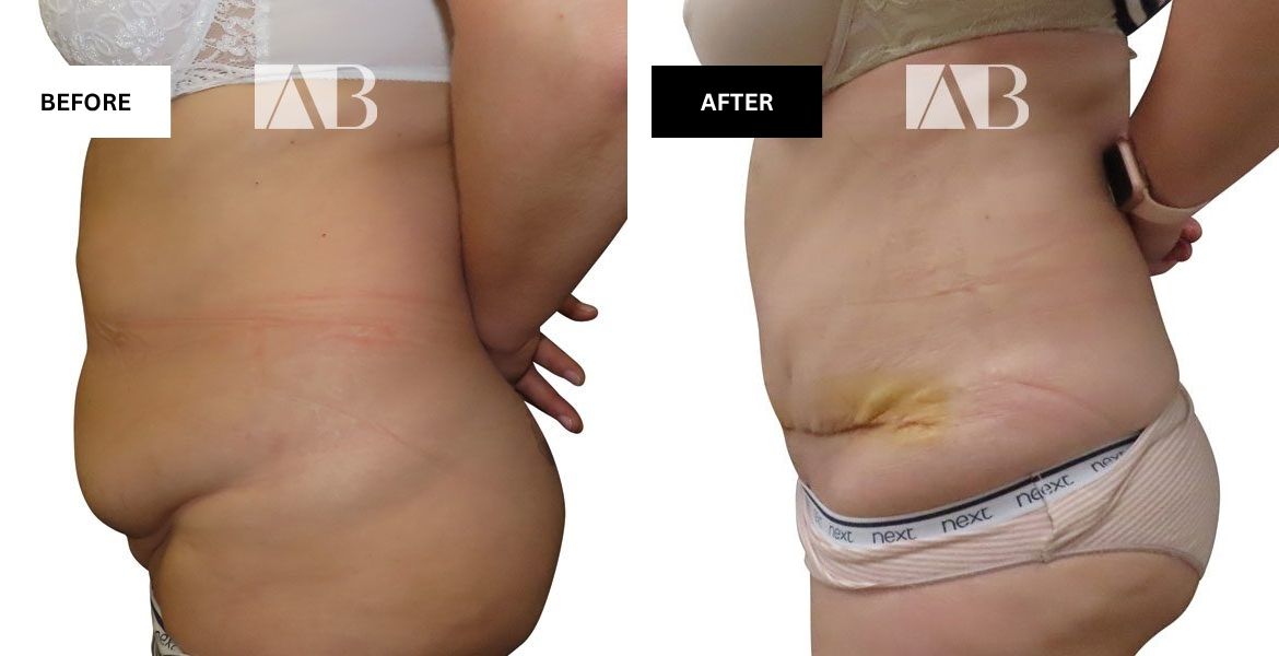 Tummy Tuck Before and After Photo Patient 6 - Left Side