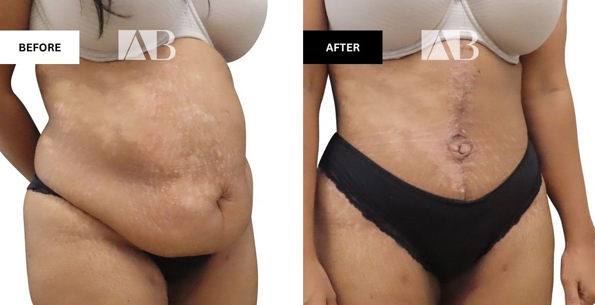 Tummy Tuck Before and After Photo Patient 7 - 45 degree