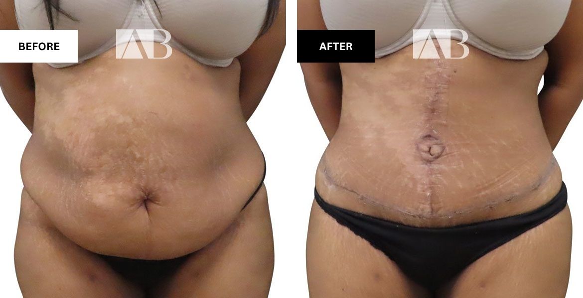 Tummy Tuck Before and After Photo Patient 7 - Front View