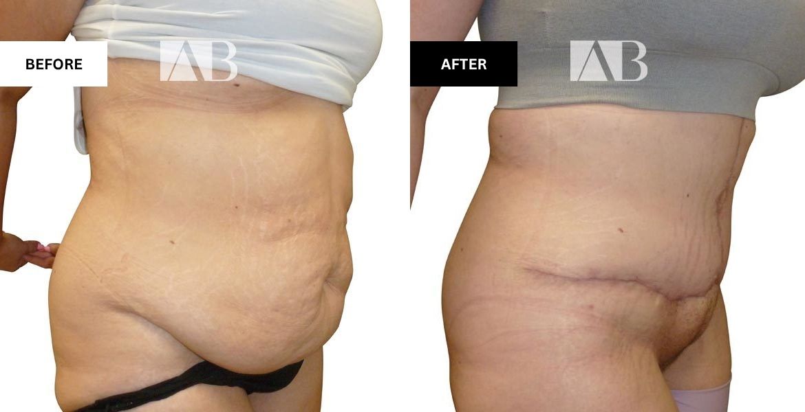 Tummy Tuck Before and After Photo Patient 9 - 45 degree