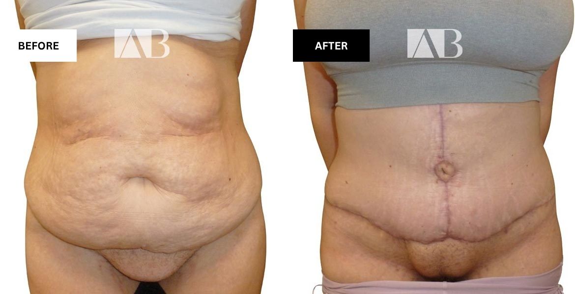 Tummy Tuck Before and After Photo - Patient 9 - Front View