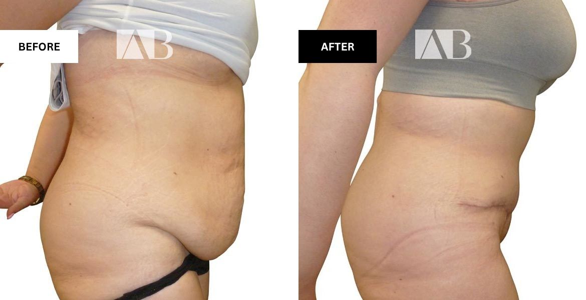 Tummy Tuck Before and After Patient 9 - Right Side