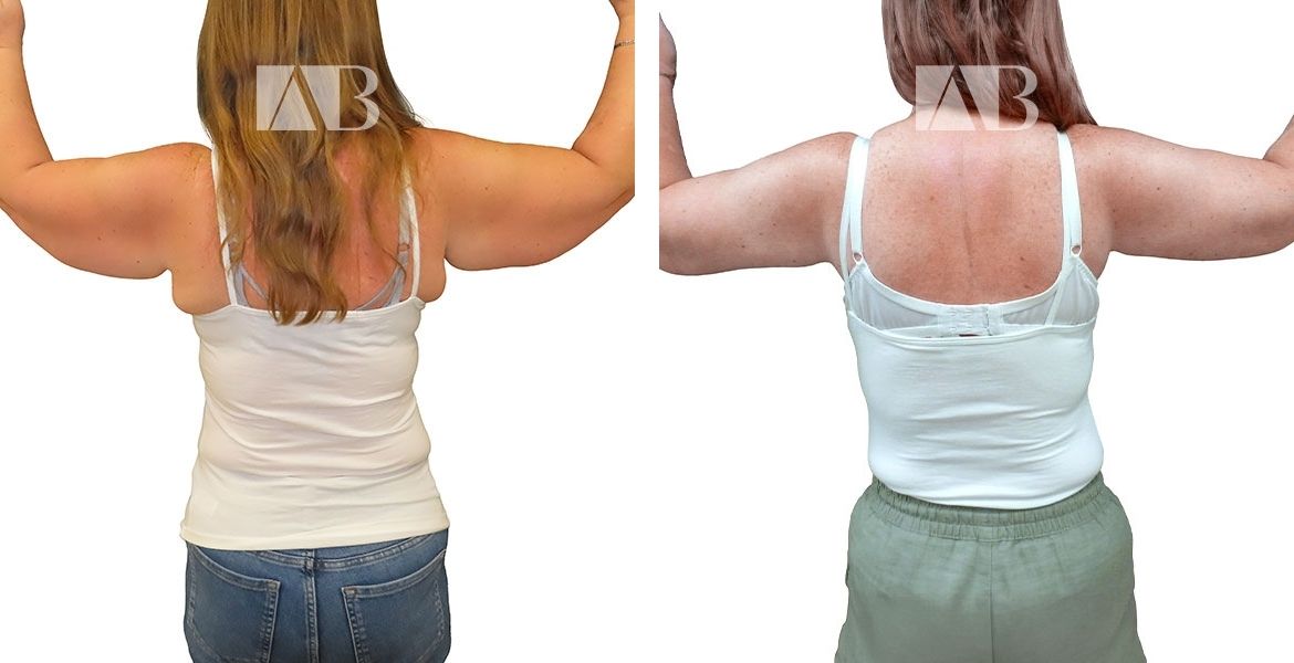 Arm Reduction Before and After Photo – Patient 1 Arm Raise