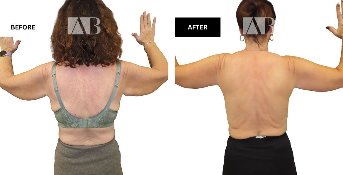 Arm Reduction Before and After Photo – Patient 2 Back side