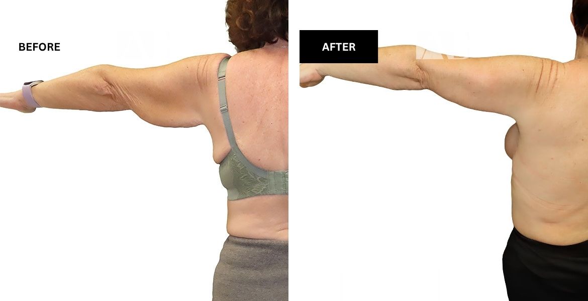 Arm Reduction Before and After Photo – Patient 2 Left Arm Side