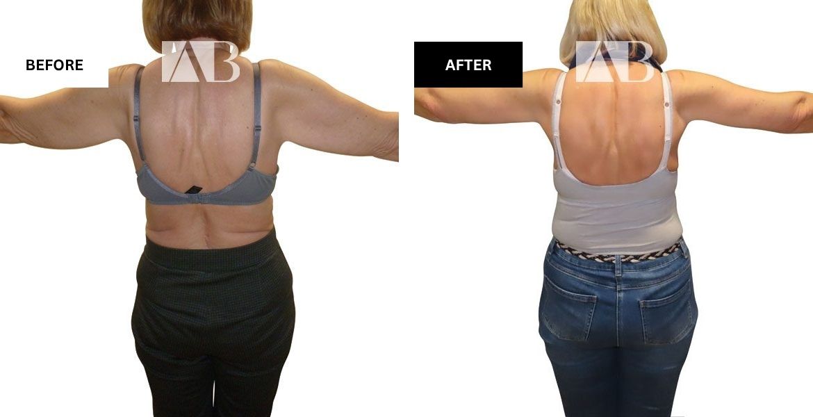 Arm Reduction Before and After Photo – Patient 4 Back View