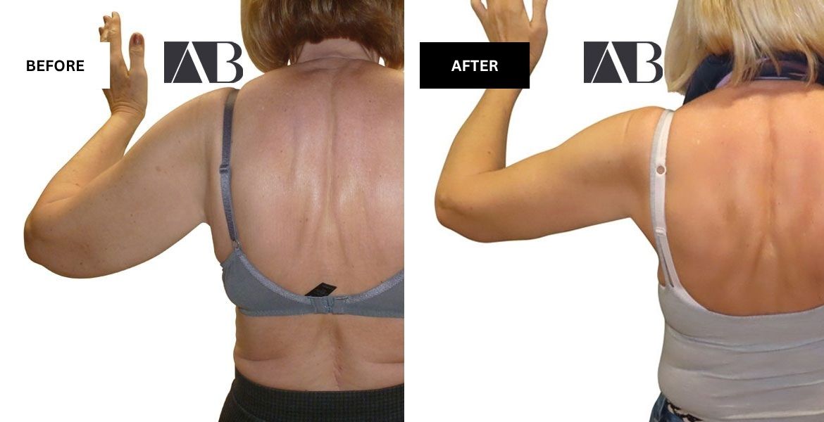 Arm Reduction Before and After Photo – Patient 4 Left Arm