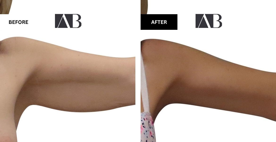 Arm Reduction Before and After Photo – Patient 5 Left Arm