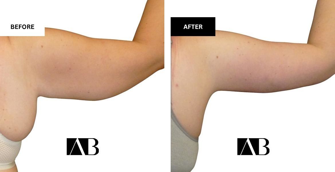 Arm Reduction Before and After Photo – Patient 6 Back Right Arm