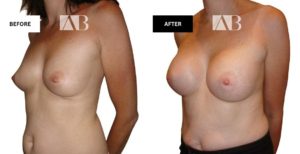 Breast Enlargement Before and After Photo - Patient 10 - 45 degree