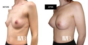 Breast Enlargement Before and After Photo - Patient 14 - 45 degree