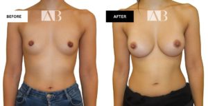 Breast Enlargement Before and After Photo - Patient 3 Front View