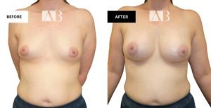 Breast Enlargement Before and After Photo - Patient 4 Front View