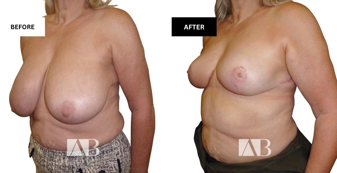 Breast Reduction Before and After Photo – Patient 18 – 45 degree