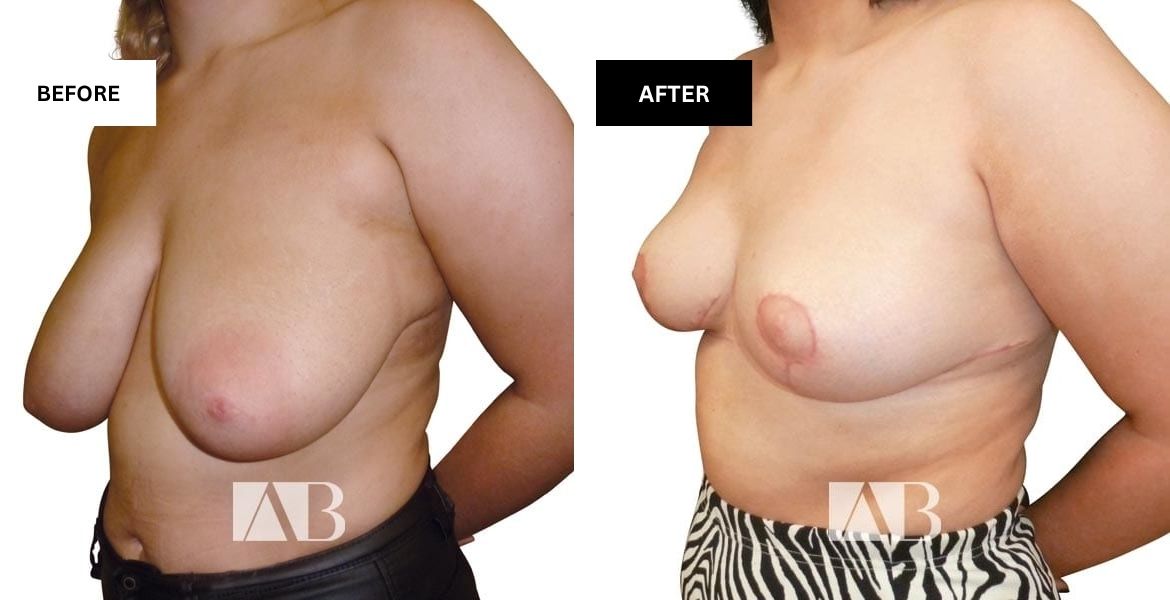 Breast Reduction Before and After Photo – Patient 19 – 45 degree