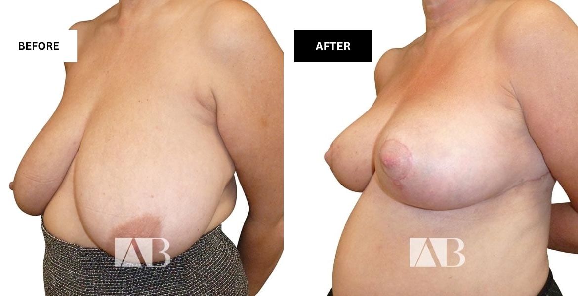 Breast Reduction Before and After Photo – Patient 20 – 45 degree