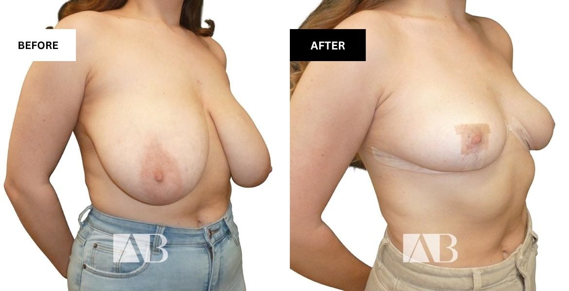 Breast Reduction Before and After Photo – Patient 21 – 45 degree
