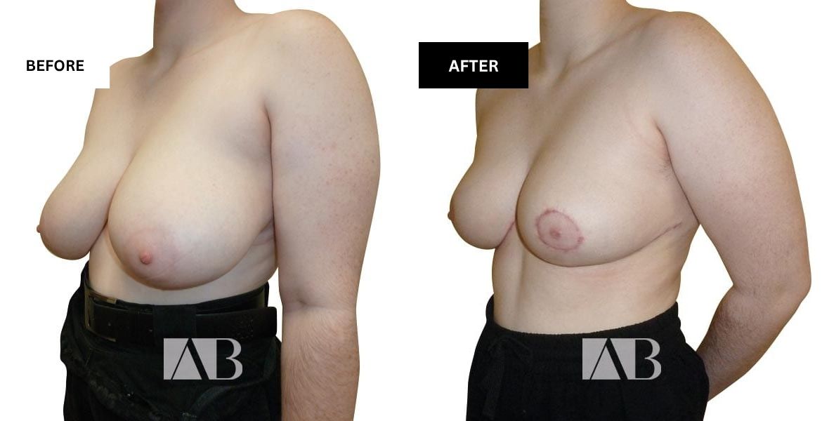 Breast Reduction Before and After Photo – Patient 22 – 45 degree