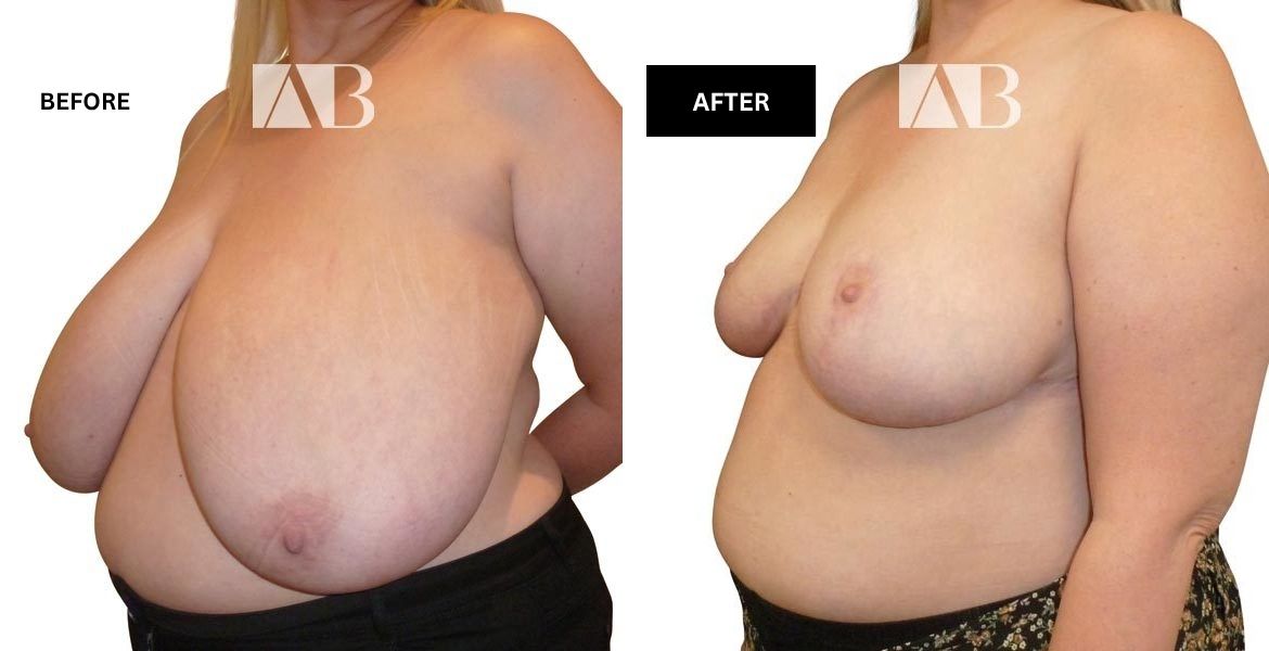 Breast Reduction Before and After Photo – Patient 9 – 45 degree