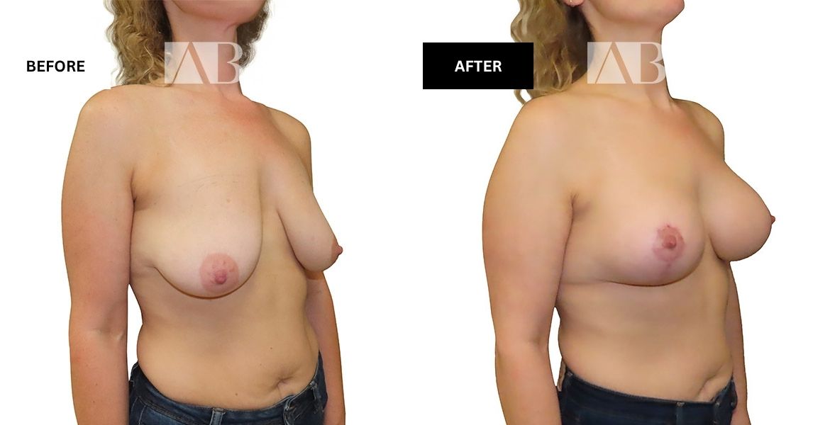 Breast Uplift Before and After Photo – Patient 1 - 45 degree