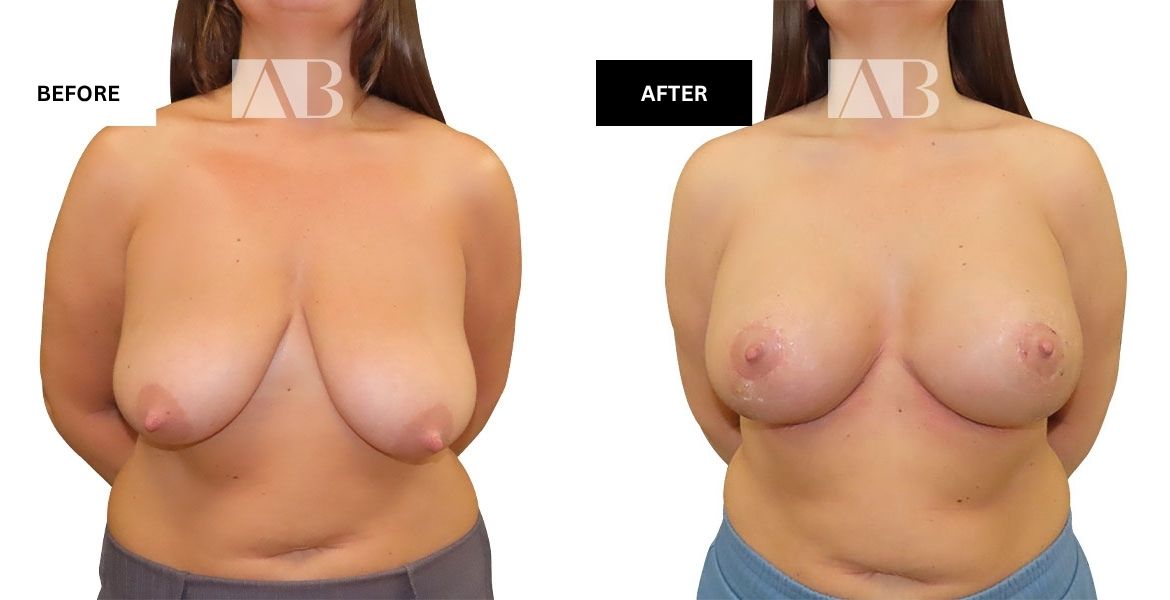 Breast Uplift Before and After Photo – Patient 2 Front View