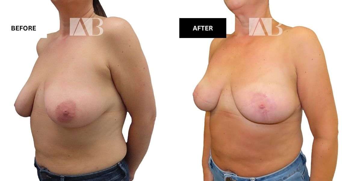 Breast Uplift Before and After Photo – Patient 3 – 45 degree