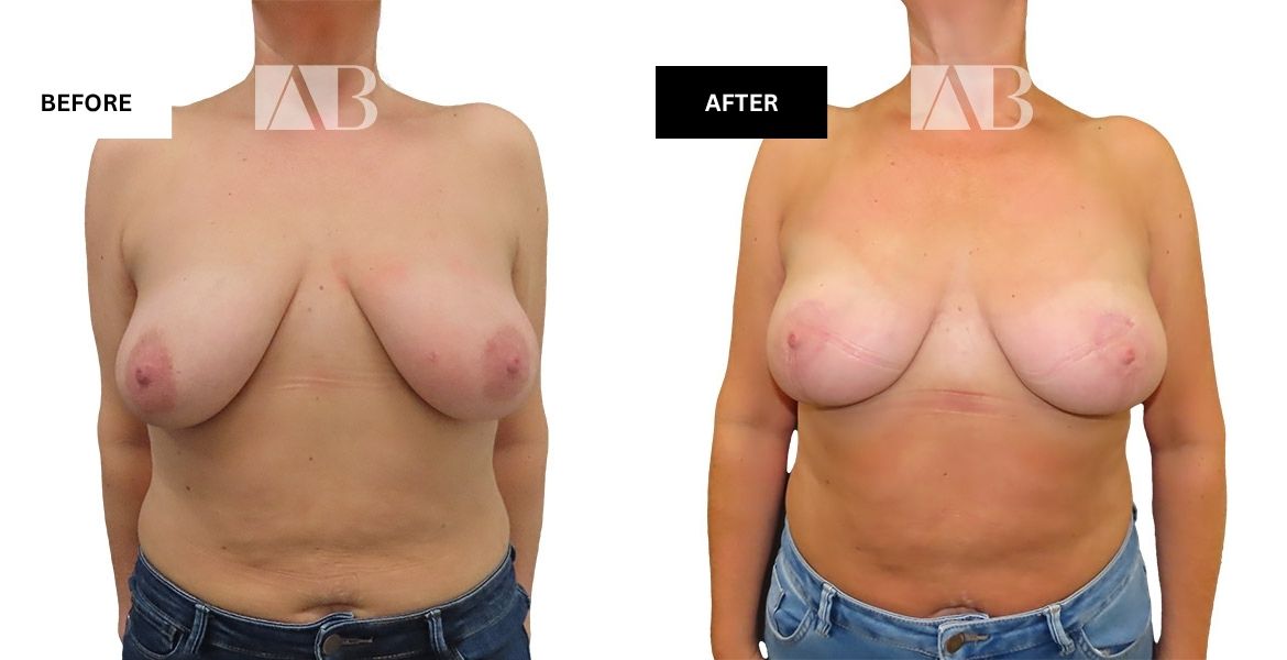 Breast Uplift Before and After Photo – Patient 3 Front View