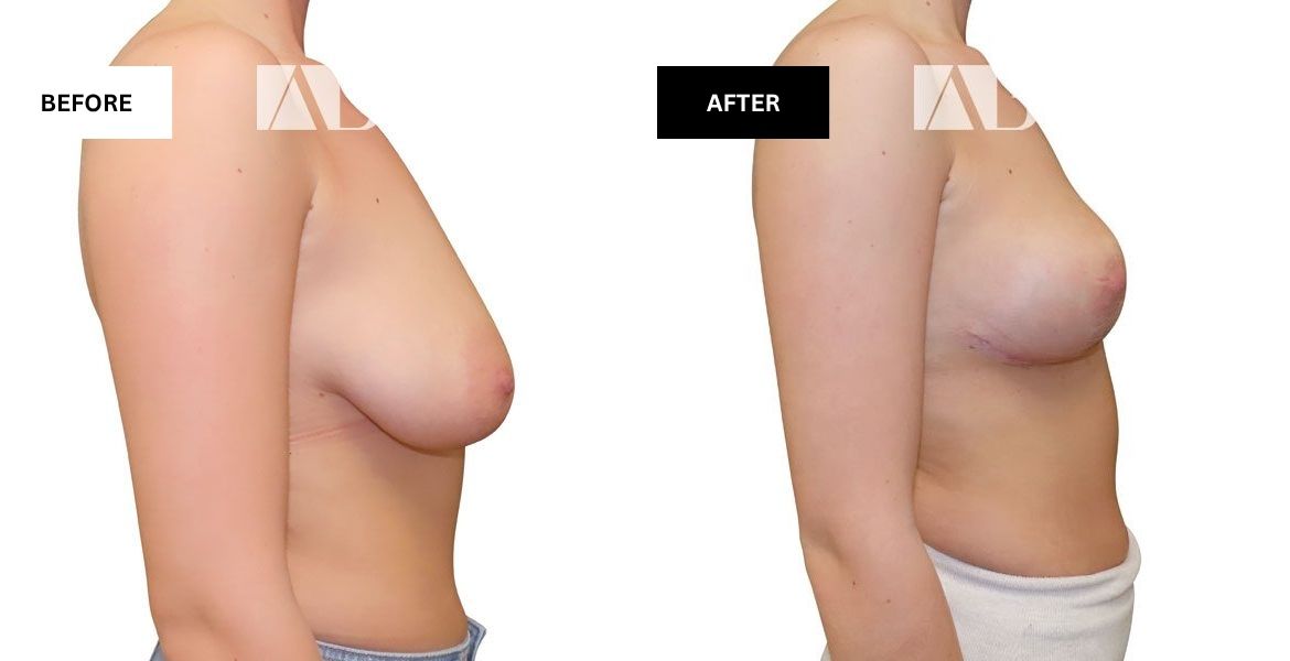 Breast Uplift Before and After Photo – Patient 4 Right View