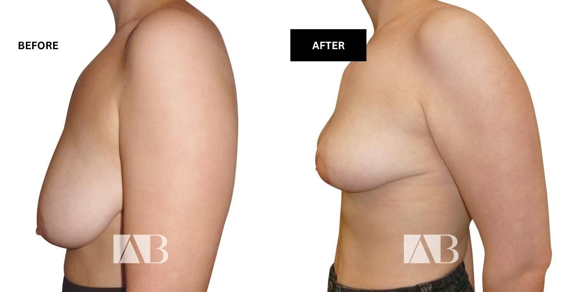 Breast Uplift Before and After Photo – Patient 6 Left Side