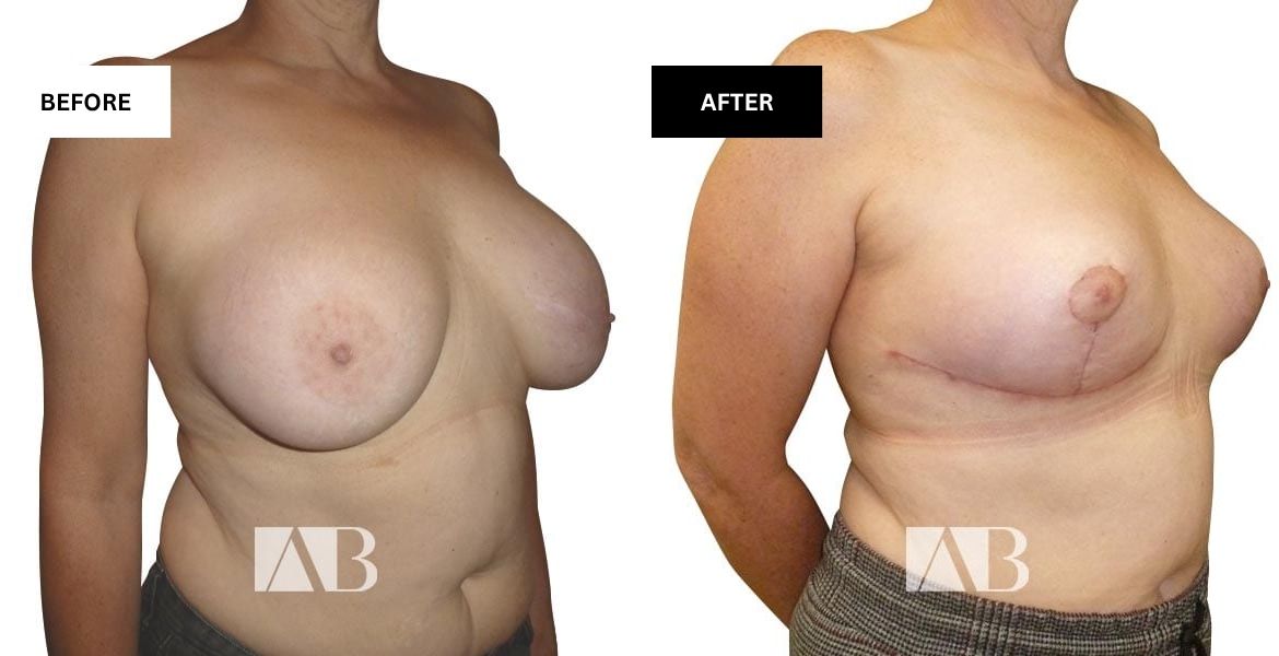 Breast Uplift Before and After Photo – Patient 7 – 45 degree