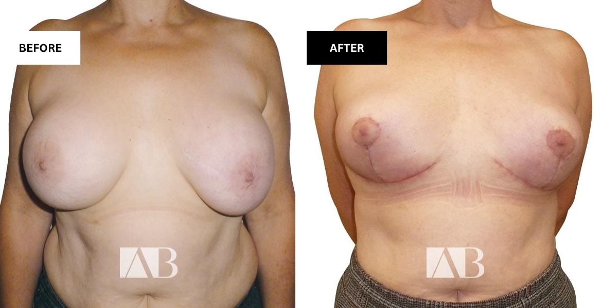 Breast Uplift Before and After Photo – Patient 7 Front View