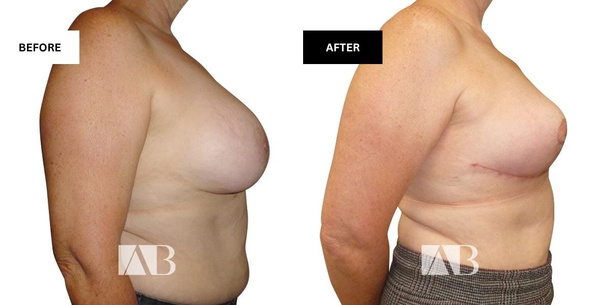 Breast Uplift Before and After Photo – Patient 7 Right Side