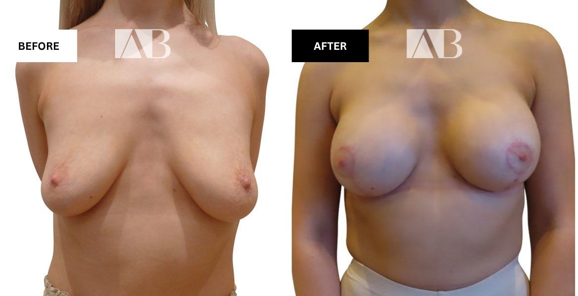 Breast Uplift + Enlargement Before and After Photo – Patient 3 Front View