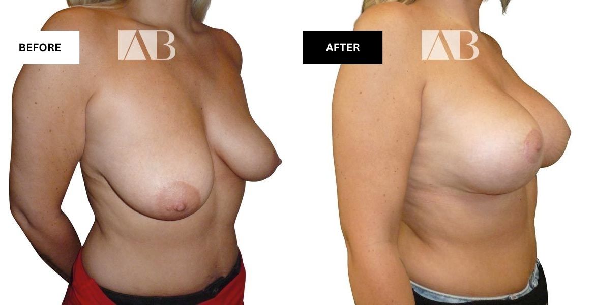 Breast Uplift + Enlargement Before and After Photo – Patient 4 – 45 degree