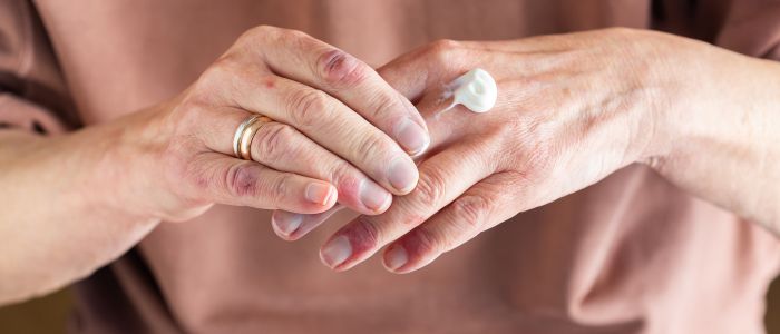 Contact Dermatitis Image - hand