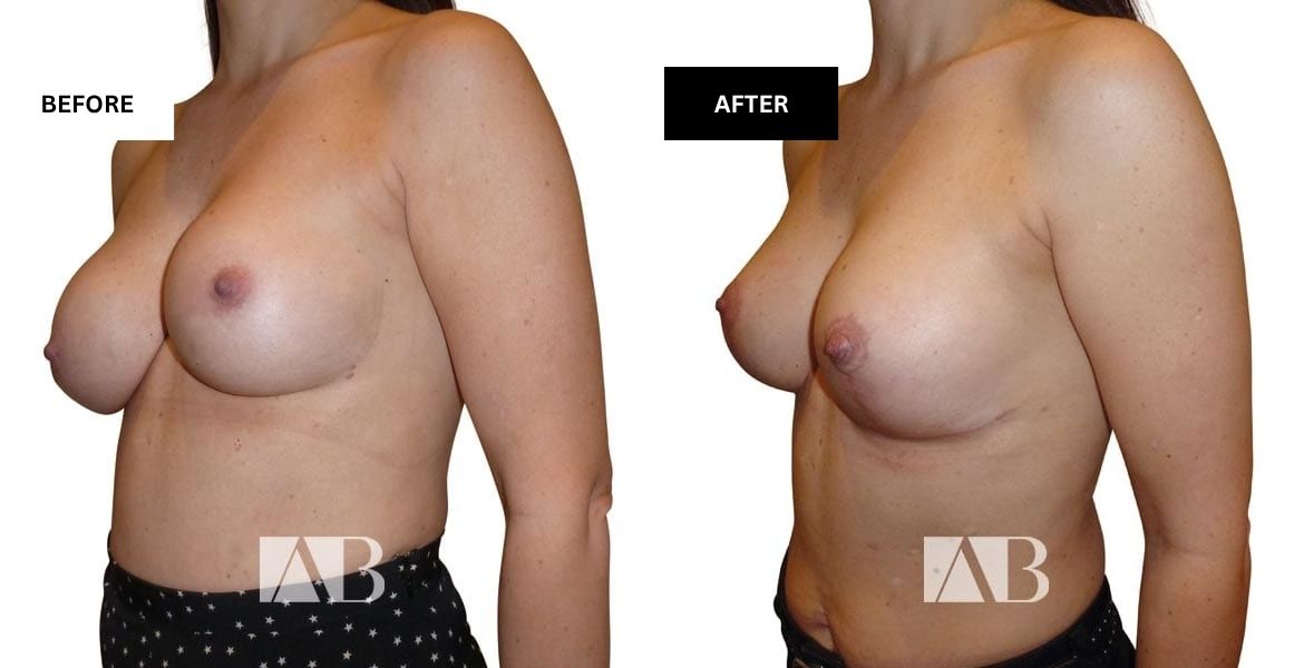 Implant Exchange Before and After Photo – Patient 2 – 45 degree