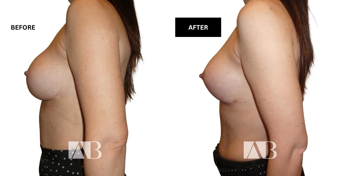 Implant Exchange Before and After Photo – Patient 2 Left Side