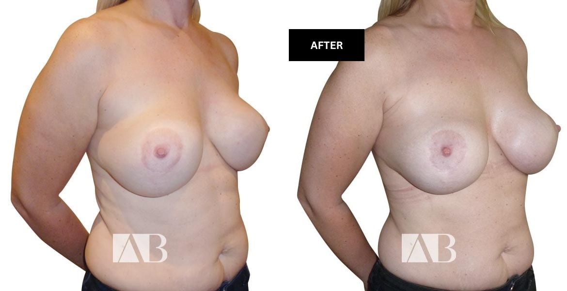Implant Exchange Before and After Photo – Patient 3 – 45 degree
