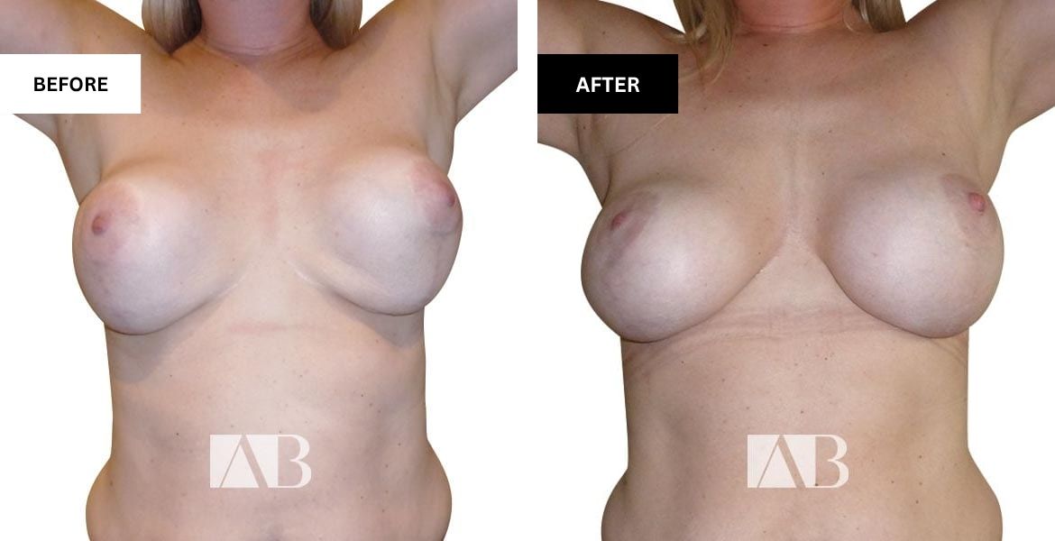 Implant Exchange Before and After Photo – Patient 3 Front View Hand raise