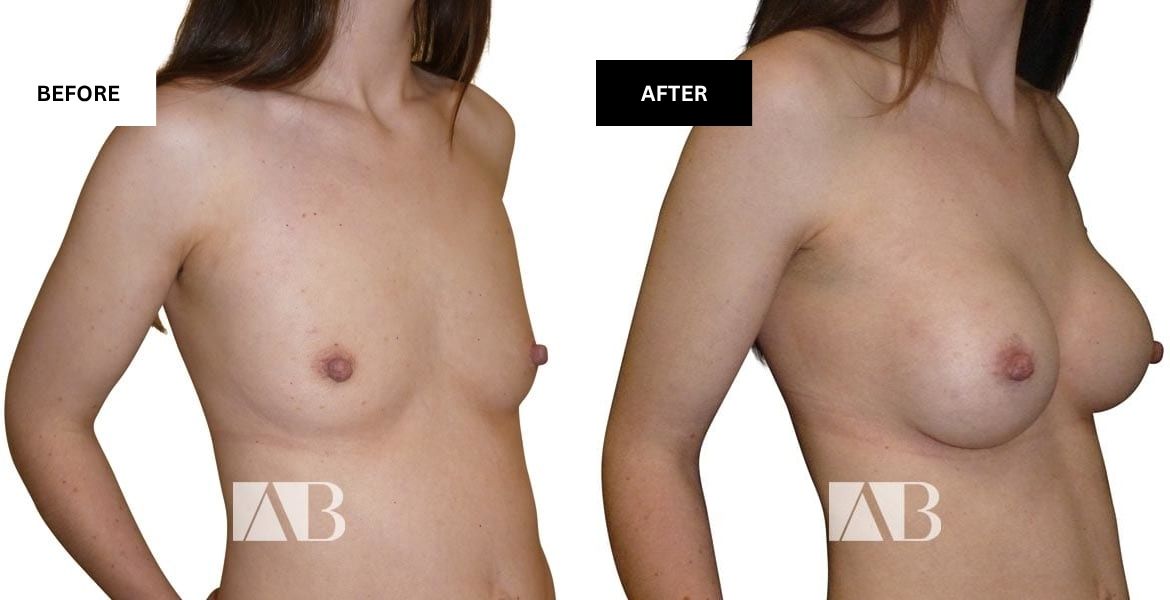 Implant Shapes + Sizes Before and After Photo - Patient 1