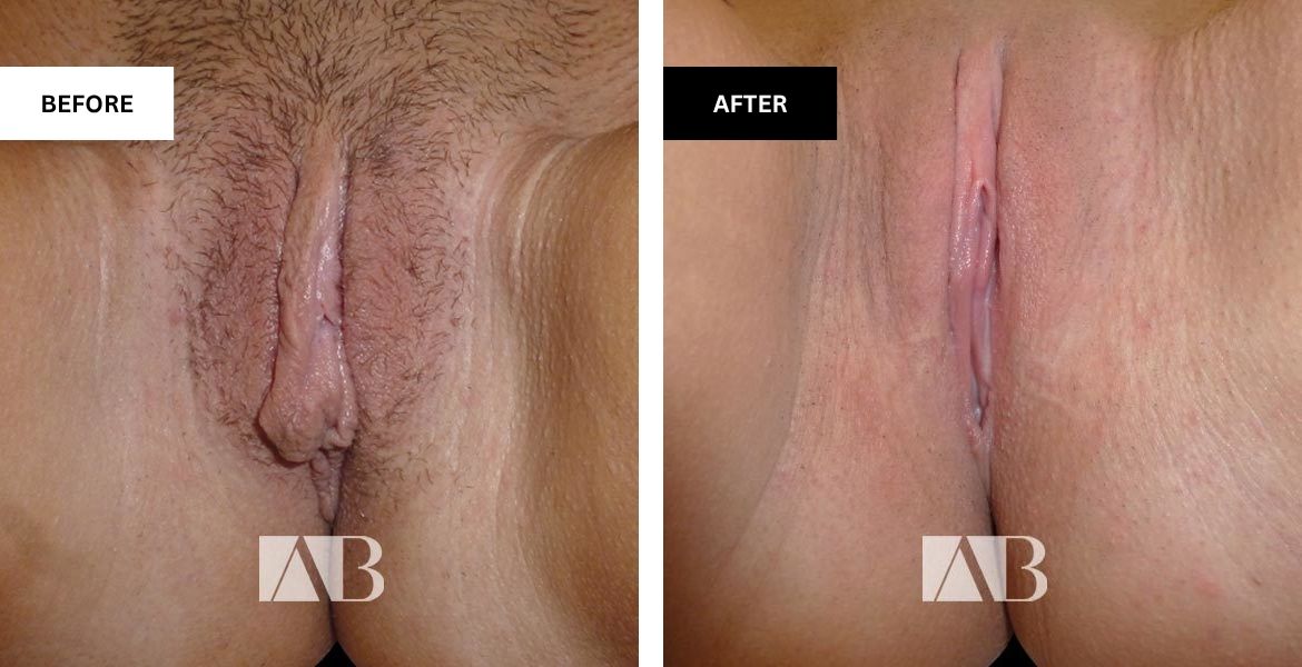 Labiaplasty Before and After Photo - Patient 10