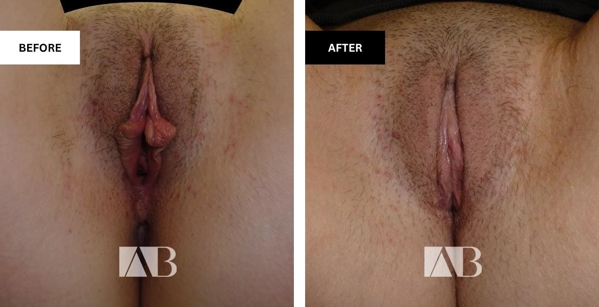 Labiaplasty Before and After Photo - Patient 11