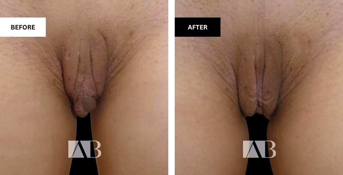 Labiaplasty Before and After Photo - Patient 14