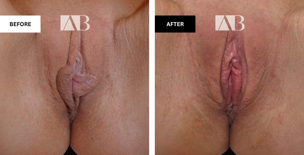Labiaplasty Before and After Photo - Patient 5