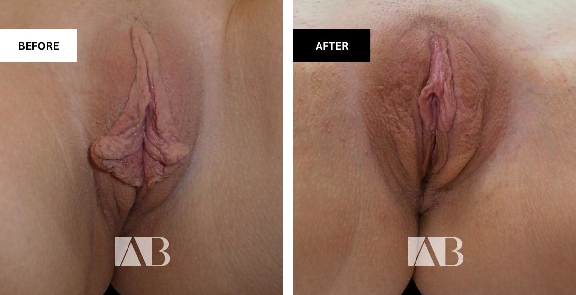 Labiaplasty Before and After Photo - Patient 8