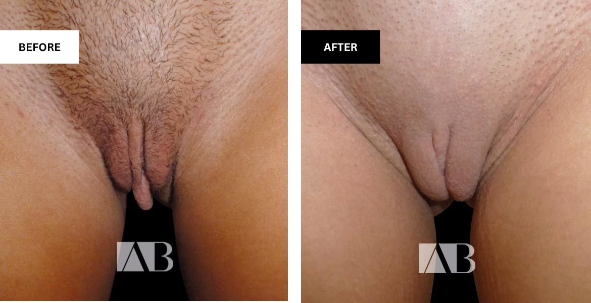 Labiaplasty Before and After Photo - Patient 9