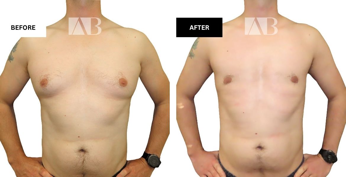 Male Breast Reduction Before and After Photo – Patient 1 Front View